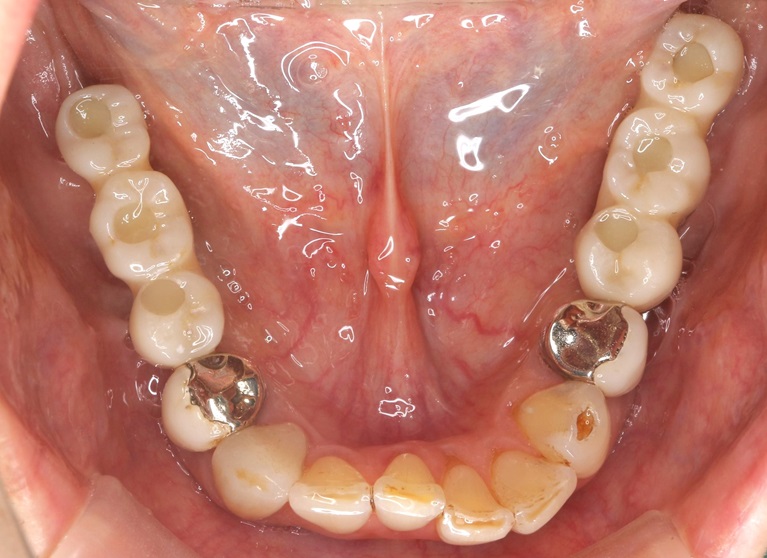 症例②　複数歯に渡るインプラント埋入②after