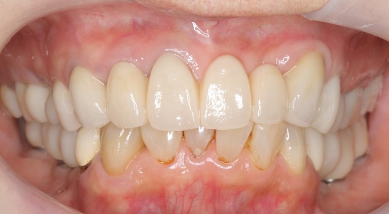 症例②　複数歯に渡るインプラント埋入①after