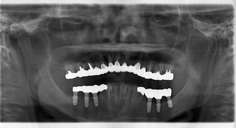 症例②　複数歯に渡るインプラント埋入