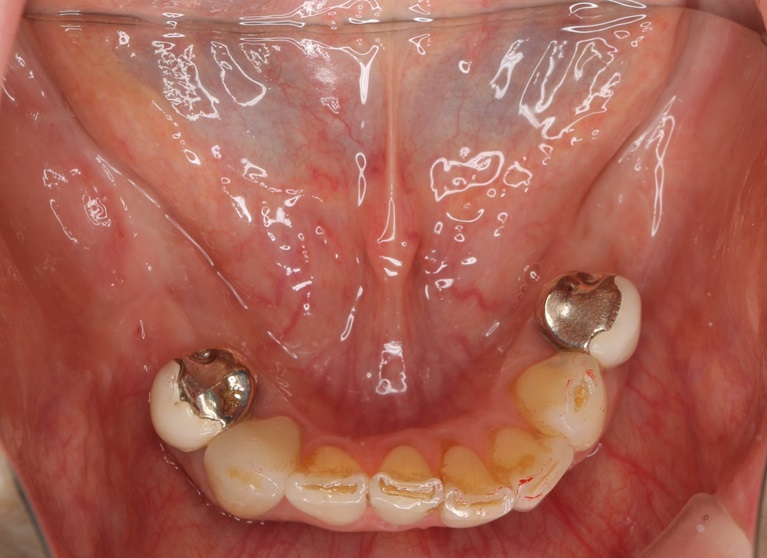 症例②　複数歯に渡るインプラント埋入②before