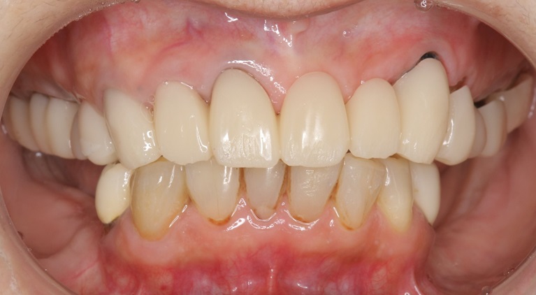 症例②　複数歯に渡るインプラント埋入①before