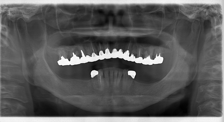 症例②　複数歯に渡るインプラント埋入