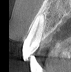 歯科用CTの歯周病診断への応用