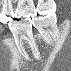 複雑な根管の走行状態がわかる