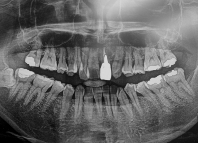 全顎レントゲン撮影