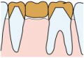 ブリッジ 支えとなる歯を削ります