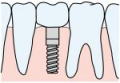 インプラント ブリッジや入れ歯の欠点を補います