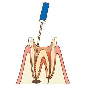 歯の根の病気