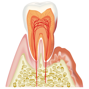 歯肉炎・軽度歯周炎