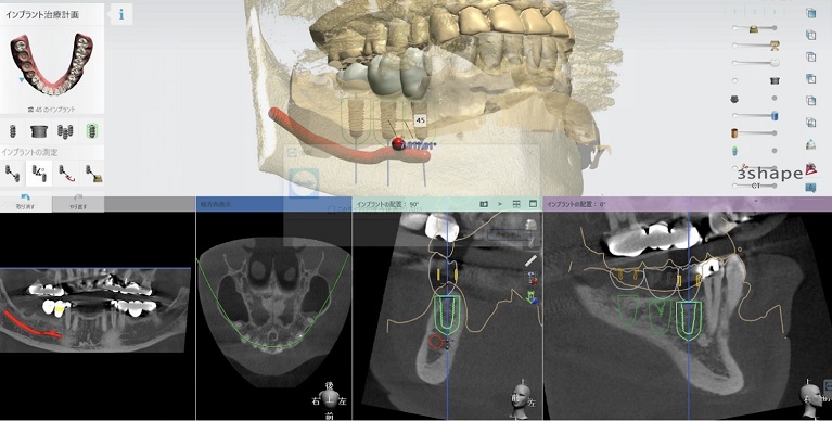 インプラントシミュレーションソフト