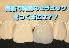 セラミック治療を支える歯科技工士の技！