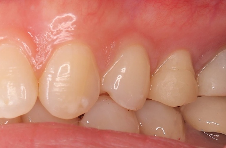 オーバーレイafter