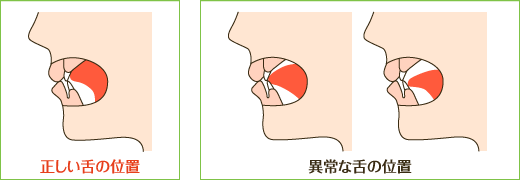 正しい舌の置く場所スポットとは一体どこなのでしょうか。