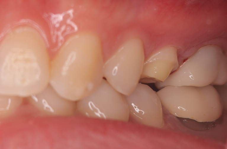 オーバーレイbefore