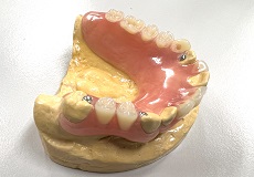 ノンクラスプデンチャーと高分子材料