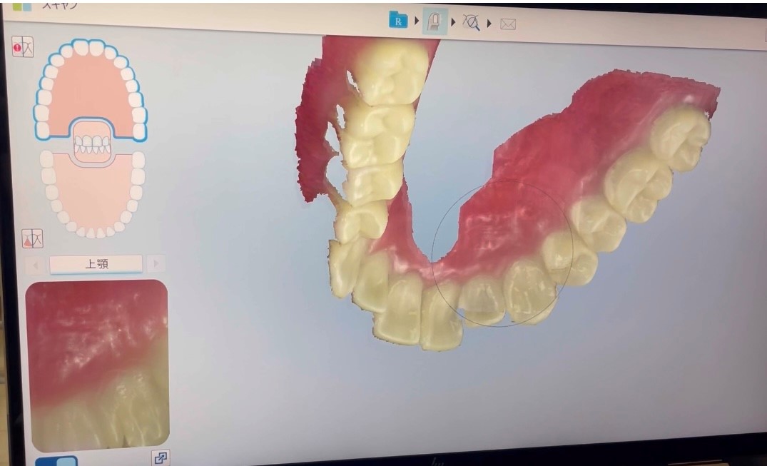 小室歯科・矯正歯科近鉄あべのハルカス診療所のiTero活用法