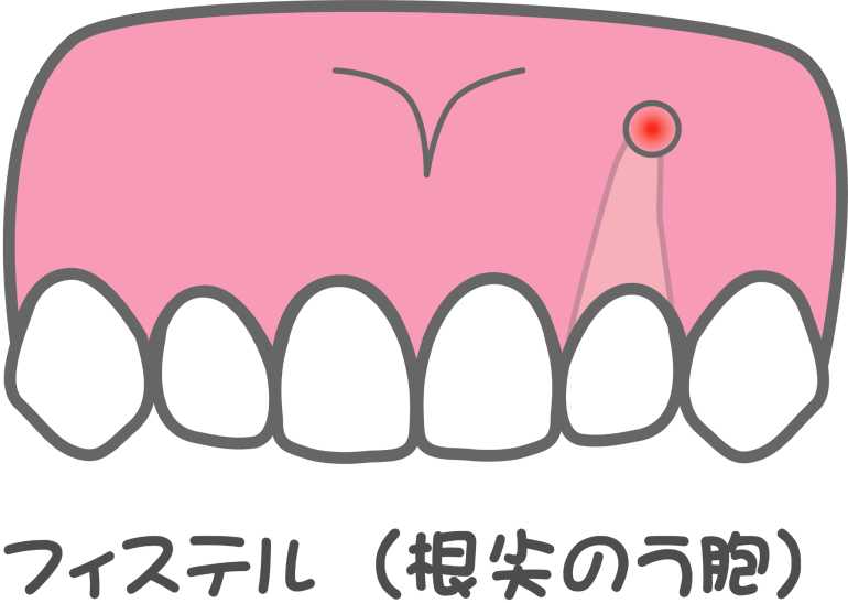 フィステル/サイナストラクト（瘻孔）