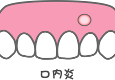 口内炎（アフタ性が一般的）