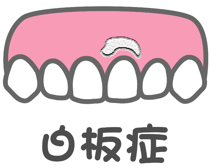 白板症（前がん病変）