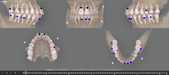 デジタル技術を使った矯正治療とは