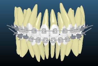ワイヤー矯正も、デジタルが進化しています