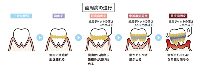 歯周病の進行段階
