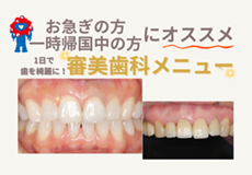短期間で歯をキレイにしたい方へ