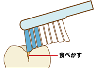 子どもの虫歯ができやすい場所