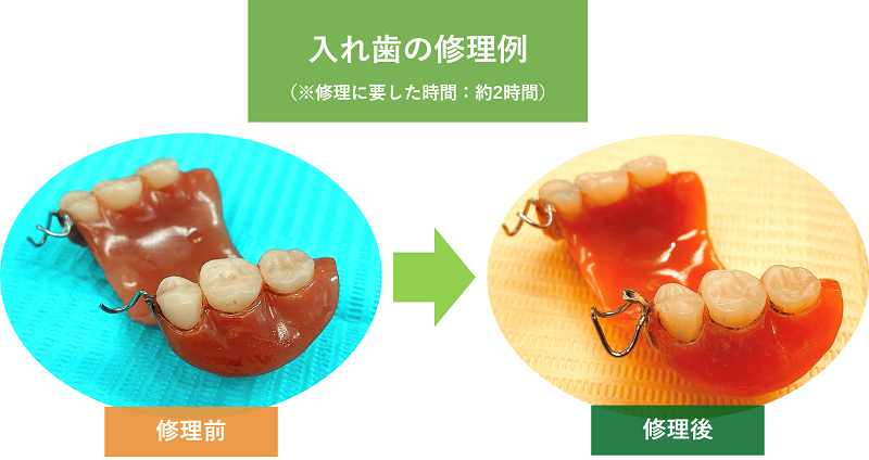 入れ歯の修理例