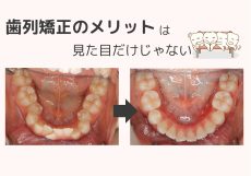 矯正治療のメリット！見た目以外にもたくさんあります。