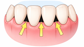 歯と歯・歯茎の間に黒い隙間ができるブラックトライアングルとは