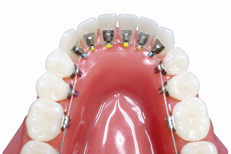 舌側矯正（リンガル矯正）とは