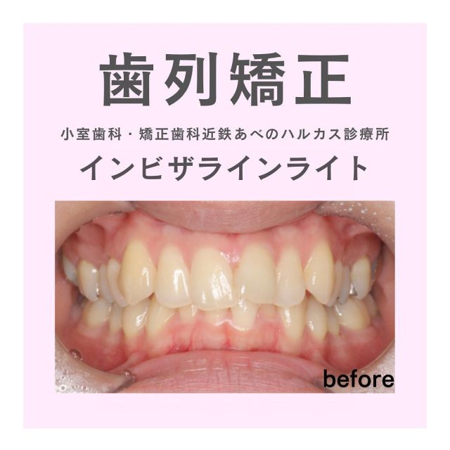 ⠀
⠀
インビザラインライトの症例写真です！🦷✨️

前歯のガタガタがお悩みの患者様でしたので、インビザラインライトでマウスピース矯正をされました！

オンライン相談で計画立ててからの治療だったのでとてもスムーズに治療が行えました🙌🏻

他にも保険の銀歯からセラミックにやりかえされました！

審美性が優れ、お口の健康のためにもなりとても素晴らしいです🥹🩵

ーーーーー一ーーーーーーーーーーーーーー

🍀小室歯科近鉄あべのハルカス診療所🍀
◇診療時間◇10:00-13:00 14:00-20:00

無料LINE相談はこちらのQRコードから登録お願いします🕊

ーーーーー一ーーーーーーーーーーーーーー
#小室歯科近鉄あべのハルカス診療所
#小室歯科#矯正歯科#小室#天王寺歯医者#大阪歯医者
#ホワイトニング#セルフホワイトニング
#天王寺#あべの#ハルカス
#デンタルエステ
#歯科矯正#矯正歯科#矯正#こども矯正#おとな矯正#インプラント#セラミック#デジタル技工#デジタル歯科
#ワイヤー矯正#MFT#デジタル矯正#アンカースクリュー
#マウスピース#マウスピース矯正
#インビザライン#invisalign
#インビザラインライト #部分矯正