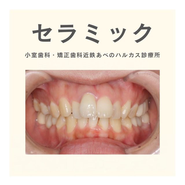 ⠀
⠀
セラミック治療の症例写真です！🦷✨️

・上前歯1本セラミッククラウン
・左上奥歯３本セラミックブリッジ
・右下奥歯3本セラミックブリッジ
・左下奥歯３本セラミックブリッジ

根管治療もあり約1年半ほど期間がかかりましたが、とても綺麗に仕上がりました😭🩵

ーーーーー一ーーーーーーーーーーーーーー

🍀小室歯科近鉄あべのハルカス診療所🍀
◇診療時間◇10:00-13:00 14:00-20:00

無料LINE相談はこちらのQRコードから登録お願いします🕊

ーーーーー一ーーーーーーーーーーーーーー
#小室歯科近鉄あべのハルカス診療所
#小室歯科#矯正歯科#小室#天王寺歯医者#大阪歯医者
#ホワイトニング#セルフホワイトニング
#天王寺#あべの#ハルカス
#デンタルエステ #ストレッチオーラル 
#歯科矯正#矯正歯科#矯正#こども矯正#おとな矯正#インプラント#セラミック#ジルコニアセラミック #デジタル技工#デジタル歯科
#ワイヤー矯正#MFT#デジタル矯正#アンカースクリュー
#マウスピース#マウスピース矯正
#インビザライン#invisalign