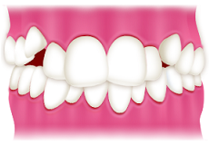 ガチャ歯・歯がガタガタの歯並びを治したい方へ
