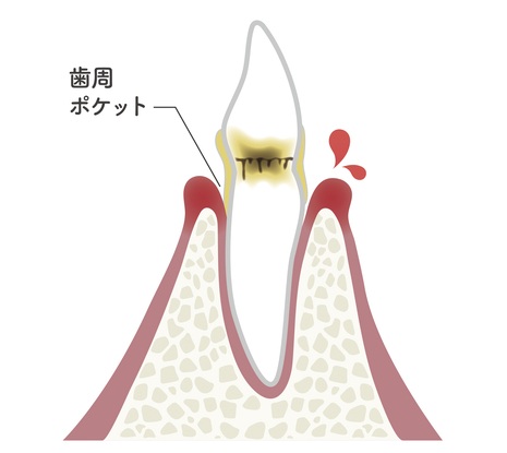 歯周病が進行する