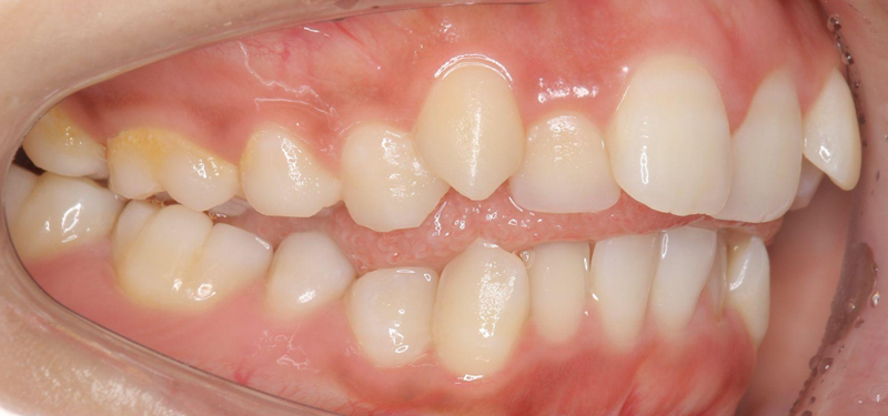 舌突出癖(ぜつとっしゅつへき)