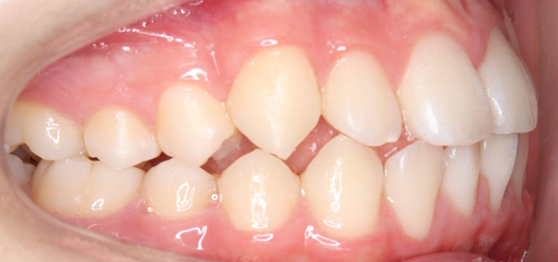 舌突出癖(ぜつとっしゅつへき)