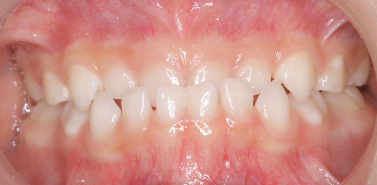 低位舌(ていいぜつ)：舌がいつも低い位置にある癖