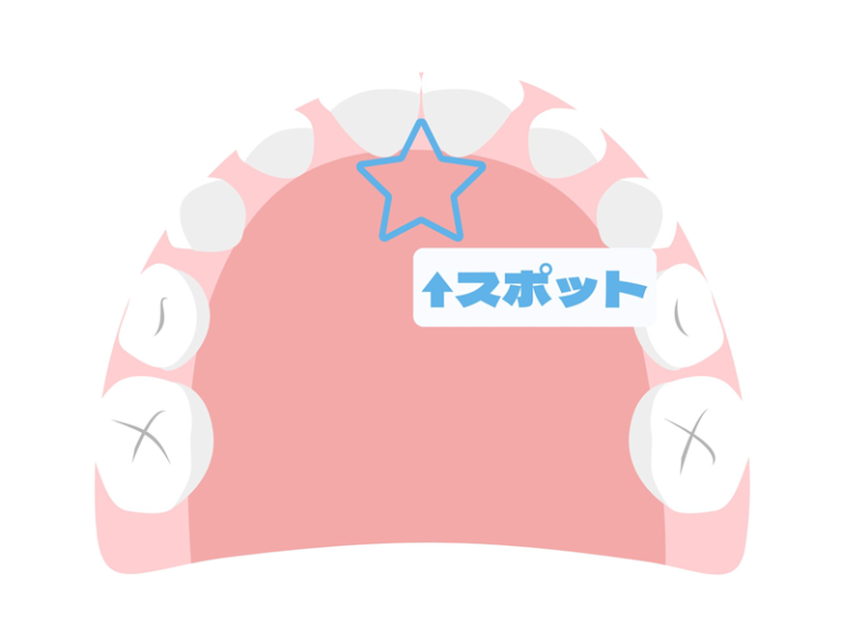 舌やお口の筋肉を正しく使うための口腔機能改善トレーニング(MFT)