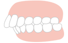 前歯・出っ歯が気になる！